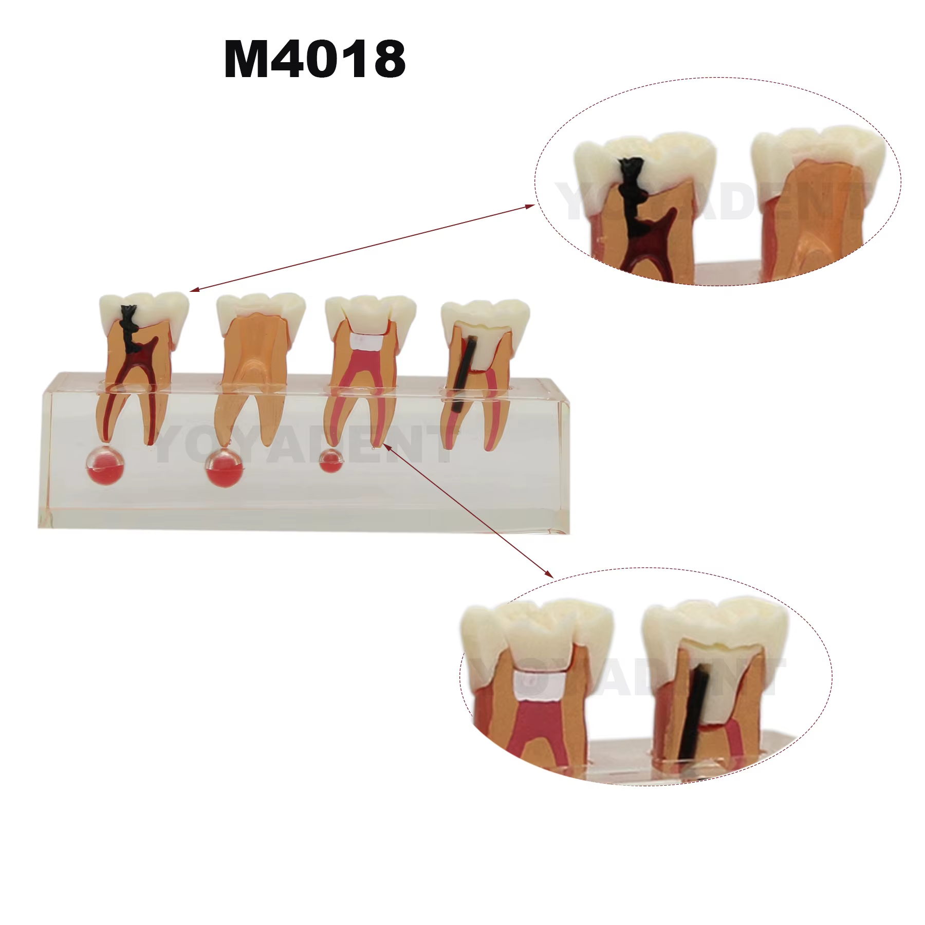 Modèle dentaire de traitement endodontique en 4 étapes et de maladie parodontale en 5 étapes pour la