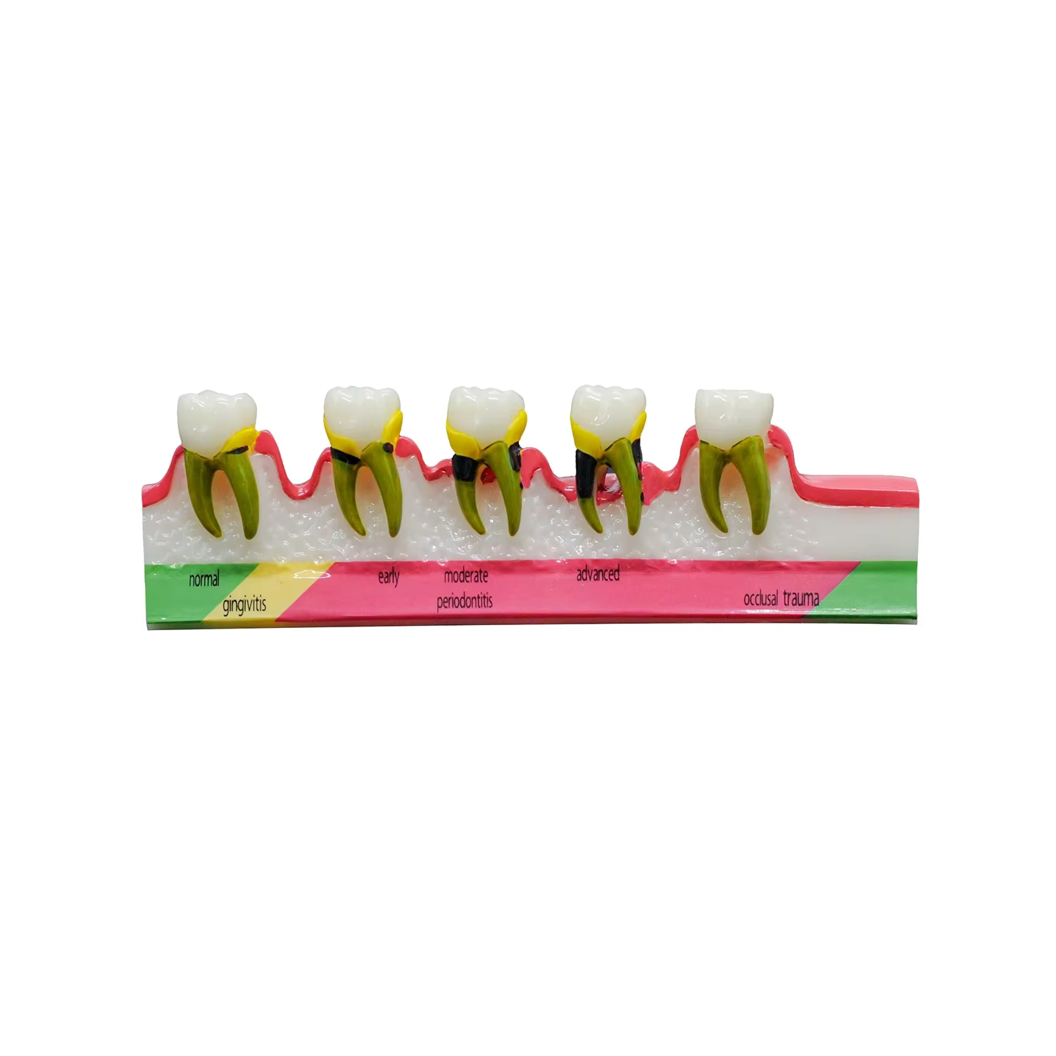 1PC étude dentaire modèle d'enseignement maladies parodontales assortiment dents Dentoform Typodont