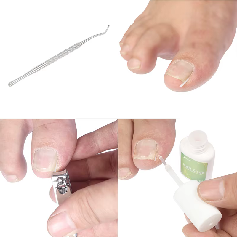 Outil de Correction des ongles incarnés, traitement des ongles incarnés, Patch élastique autocollant, Clip de redressage, attelle, outil de pédicure, 10 pièces