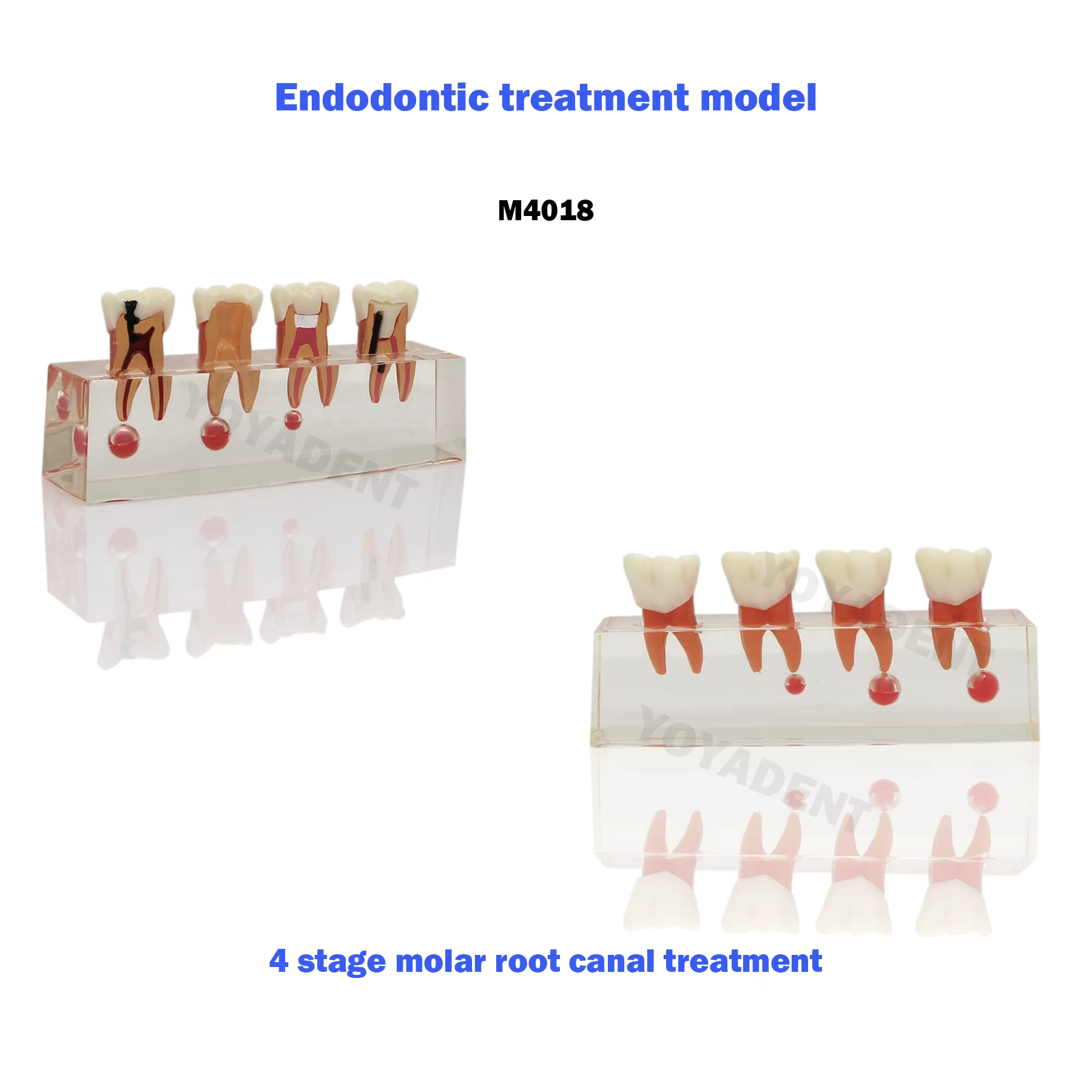 Modèle dentaire de traitement endodontique en 4 étapes et de maladie parodontale en 5 étapes pour la communication et la démonstration entre dentiste et patient