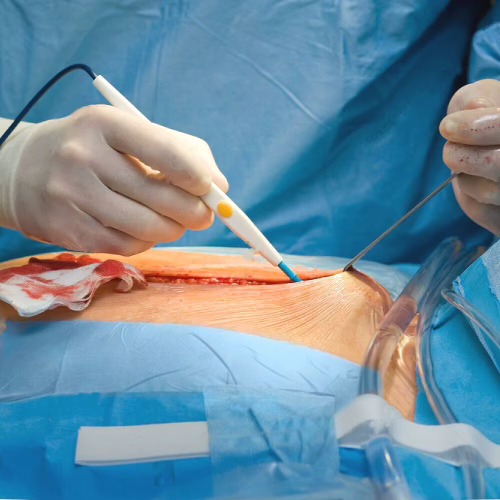 Électrode hémostatique combinée en acier au tungstène et en acier inoxydable, coupe rapide, adaptée à tous les types de procédures chirurgicales