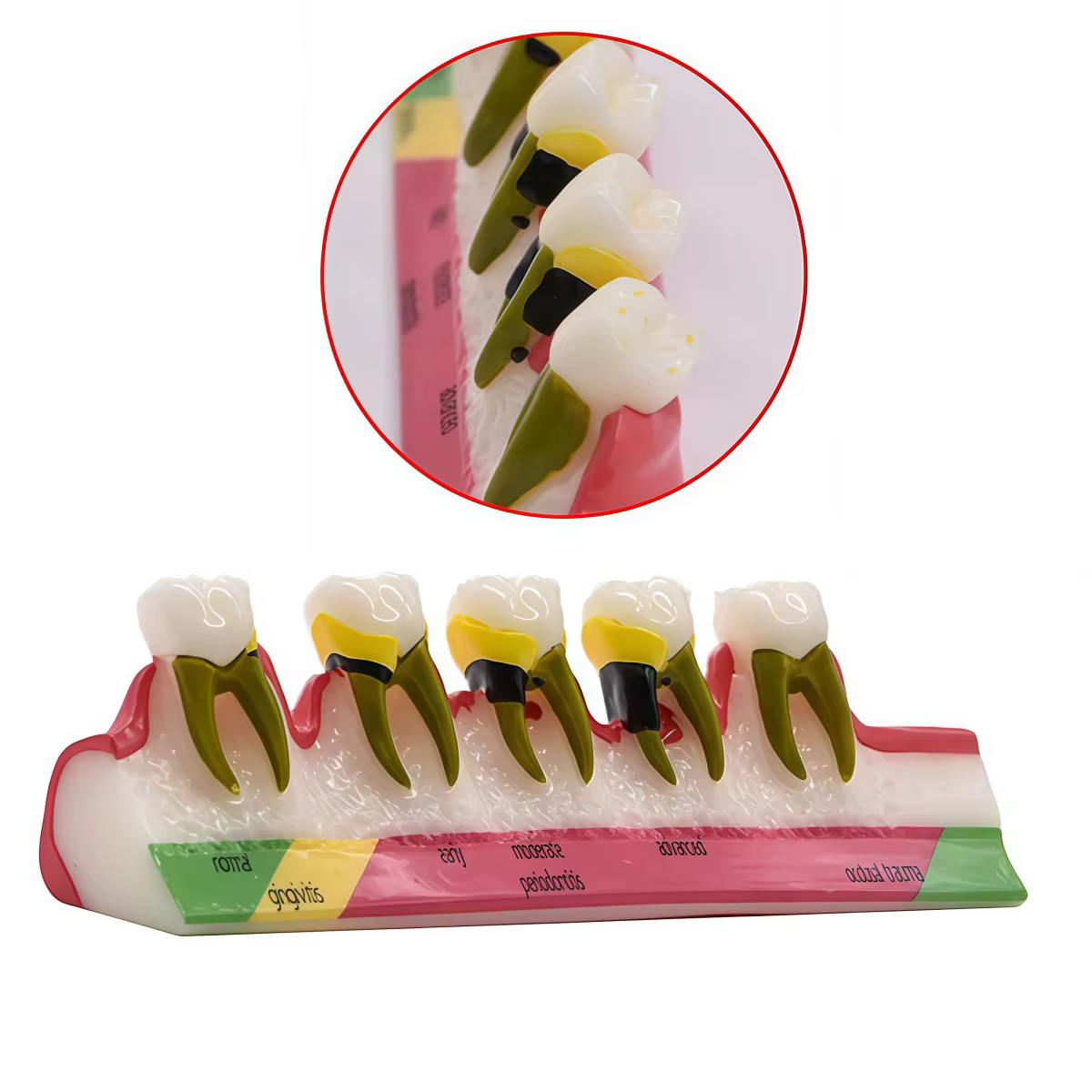 1PC étude dentaire modèle d'enseignement maladies parodontales assortiment dents Dentoform Typodont pour les étudiants dentistes étudiant enseignement