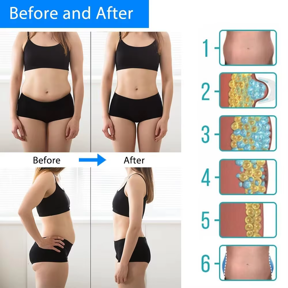 Cryothérapie pour dissoudre la graisse, thérapie par le froid, masseur anti-cellulite, machine de cryolipolyse abdominale, perte de graisse, amincissement du corps, cryolipolyse