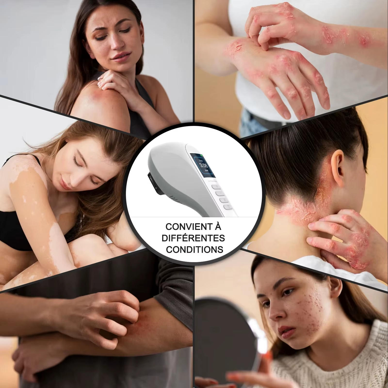 Lampe de photothérapie KTS pour traitement du vitiligo, bande étroite UV, thérapie par la lumière ultraviolette, taches de psoriasis, eczégypti, 308NM