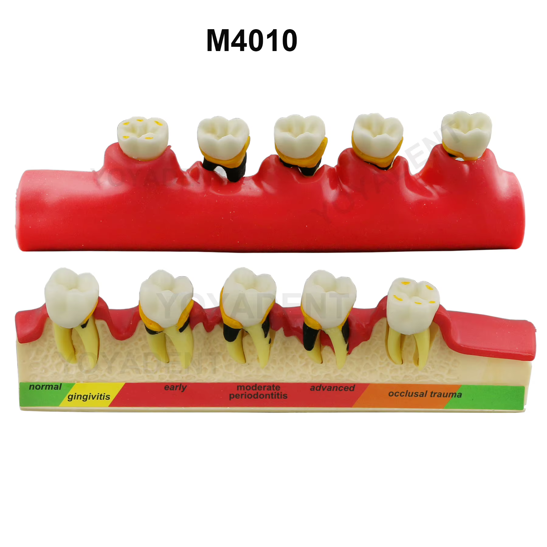 Modèle dentaire de traitement endodontique en 4 étapes et de maladie parodontale en 5 étapes pour la communication et la démonstration entre dentiste et patient